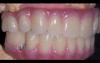 Several Teeth bimaxillary resolved with Toronto Bridges