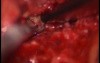 Facet Joint Synovial Cyst - Posterior Approach