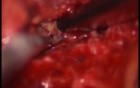Facet Joint Synovial Cyst - Posterior Approach