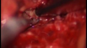 Facet Joint Synovial Cyst - Posterior Approach