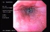 Banding of Esophageal Varices - Two Banded Varices