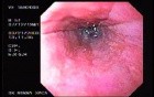 Banding of Esophageal Varices - Two Banded Varices