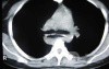 Esophagus - Pneumatic Dilation for Achalasia (26 of 31)