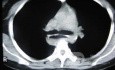 Esophagus - Pneumatic Dilation for Achalasia (26 of 31)