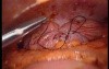 Colonic Perforation With Peritonitis - Laparoscopy (20 of 46)