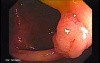 Sessile Tubulovillous Adenoma (1 of 13)