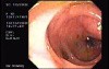 Tubulo - Villous Adenoma - Endoscopy (10 of 28)