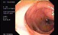 Tubulo - Villous Adenoma - Endoscopy (10 of 28)