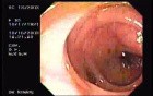 Tubulo - Villous Adenoma - Endoscopy (10 of 28)