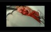 Chiloplasty by Limberg
