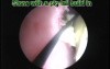 PCNL - Pig Tail Ureteric Stent