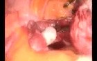 Laparoscopic Supracervical Hysterectomy (LSH)