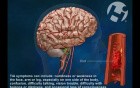 Transient Ischemic Attack (TIA)
