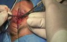 Fornix Reconstruction With Amniotic Membrane