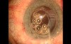 Surgical management of Capsule Contraction Syndrome - case 2