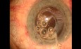 Surgical management of Capsule Contraction Syndrome - case 2