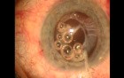 Surgical management of Capsule Contraction Syndrome - case 2