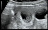 Transvaginal Fetal Reduction of a Twin Within a One Sac Monochorionic Quadruplet Pregnancy