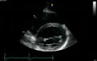 Parasternal View At The Level Of The Mitral Valve  Normal Study