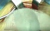 PHS- femoral hernia repair