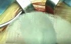 PHS- femoral hernia repair
