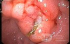 Gastroscopy - MALT Lymphoma