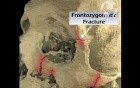 Facial Fractures