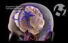 Cerebral Venous Sinus Thrombosis