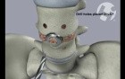 L4-5 Posterolateral Fusion