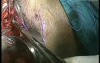 Laparoscopic Neovaginoplasty
