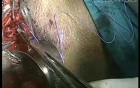 Laparoscopic Neovaginoplasty