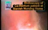 Rectum Cancer