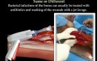 Termites & Bacteria Infection - Video Lecture