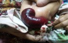 Rectal Prolapse In A Small Child - 2