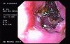 Duodenal Ulcers and Erosions (1 of 3)