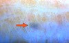 Glaucoma Surgery - Lymphatics in Glaucoma Surgery