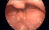 Lingual Tonsillitis - lymphoid tissue aggregations 