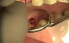 Tooth in one hour