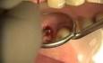 Tooth in one hour