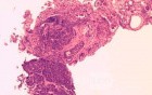 Heterotopic Pancreas with large Central Hole (4 of 6)