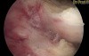 Hysteroscopic Excision of Leiomyomas