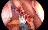 Totally transumbilical cholecystectomy