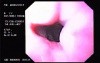 Hemorrhage due status post rubber band ligation of esophageal varices (6 of 25)