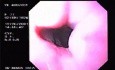 Hemorrhage due status post rubber band ligation of esophageal varices (6 of 25)