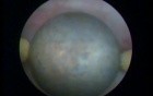 Transurethral Prostatectomy
