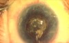 Plasma ablation capsulotomy
