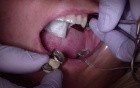 Bridge Insert: Check Bridge Pontic Site To Prevent Binding