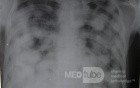 Chest X-Ray