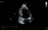 Left Ventricular Regional Wall Motion Abnormalities