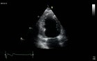 Left Ventricular Regional Wall Motion Abnormalities